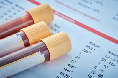 Bloedstaaltjes en resultaten om MS te diagnosticeren