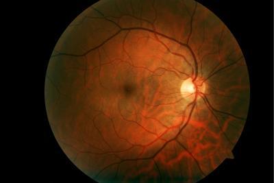 Diagnose MOGAD Optische coherentie tomografie waarbij de papil wordt onderzocht