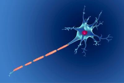 Illustratie van een zenuwcel (neuron) met een beschadigde myelineschede (hier in oranje) rond zijn axon